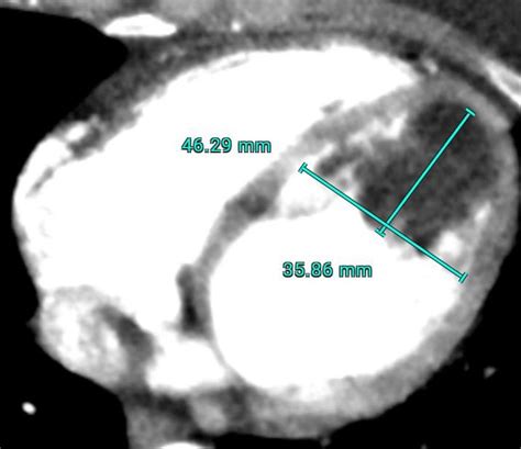 lv lipoma|endocardial lipoma.